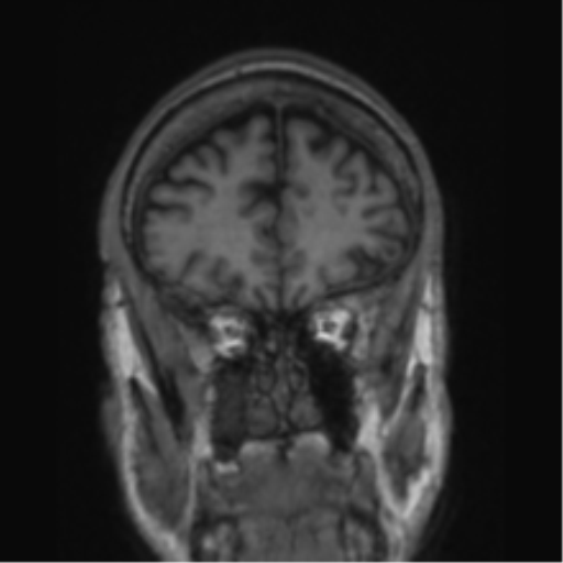 File:Alzheimer's disease- with apraxia (Radiopaedia 54763-61011 Coronal T1 72).png