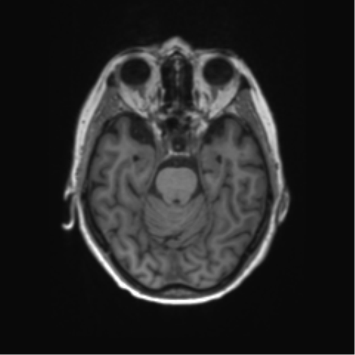 File:Alzheimer's disease (Radiopaedia 42658-45802 Axial T1 102).png