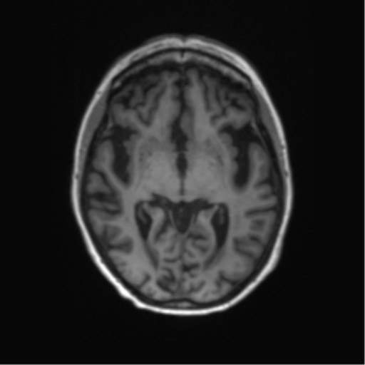 File:Alzheimer's disease (Radiopaedia 42658-45802 Axial T1 86).png