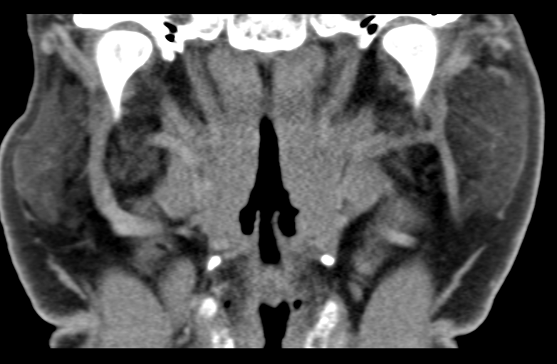Ameloblastoma (Radiopaedia 33677-34806 Coronal non-contrast 40).png