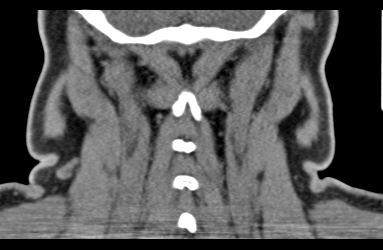 Ameloblastoma (Radiopaedia 33677-34806 Coronal non-contrast 60).png