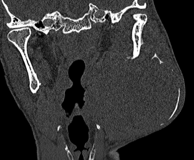 Ameloblastoma (Radiopaedia 51921-57766 Coronal bone window 176).jpg