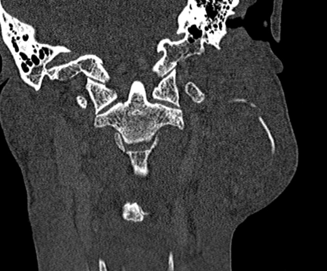 Ameloblastoma (Radiopaedia 51921-57766 Coronal bone window 224).jpg