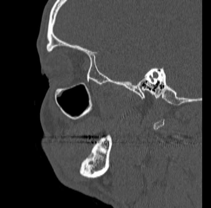Ameloblastoma (Radiopaedia 77750-89997 Sagittal bone window 66).jpg