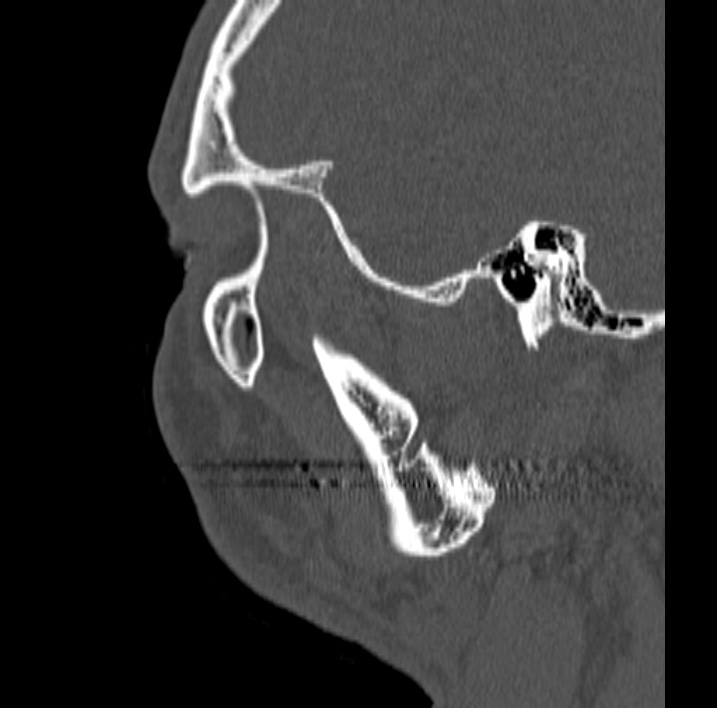 Ameloblastoma (Radiopaedia 77750-89997 Sagittal bone window 96).jpg