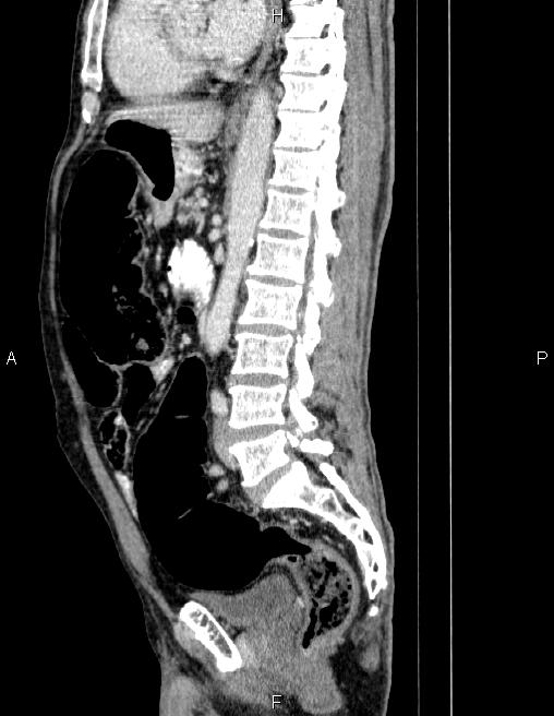 Ampullary adenocarcinoma (Radiopaedia 86093-102032 D 53).jpg