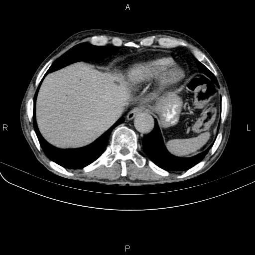 Ampullary adenocarcinoma (Radiopaedia 86093-102033 Axial C+ delayed 15).jpg