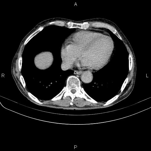 Ampullary adenocarcinoma (Radiopaedia 86093-102033 Axial C+ delayed 4).jpg