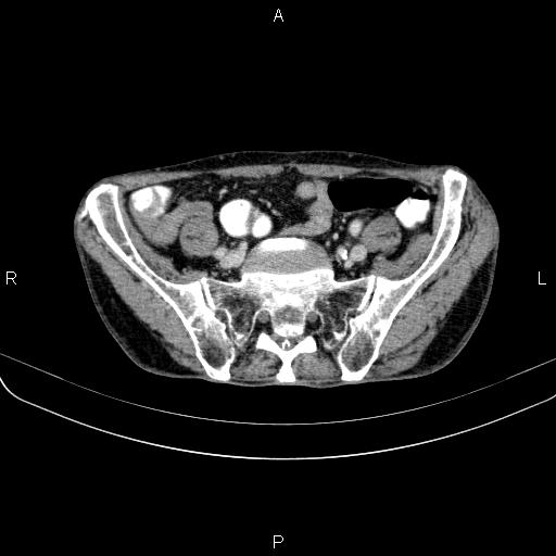 Ampullary adenocarcinoma (Radiopaedia 86093-102033 B 92).jpg