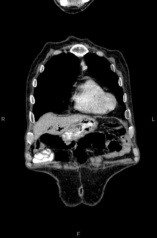 Ampullary adenocarcinoma (Radiopaedia 86093-102033 D 8).jpg