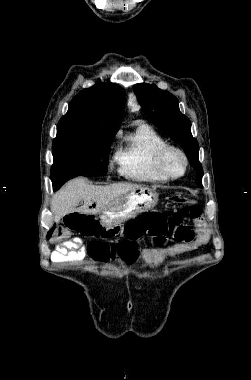 Ampullary adenocarcinoma (Radiopaedia 86093-102033 D 9).jpg