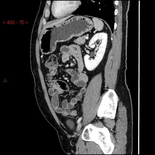 Ampullary carcinoma (Radiopaedia 56396-63056 D 74).jpg
