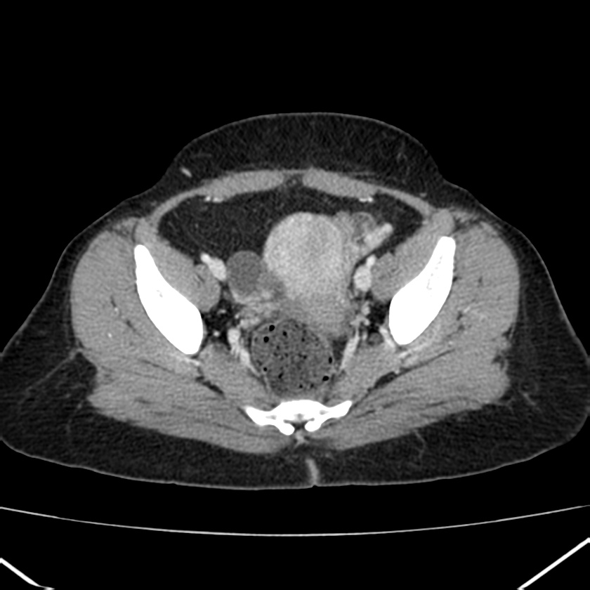 Ampullary tumor (Radiopaedia 22787-22816 C 59).jpg