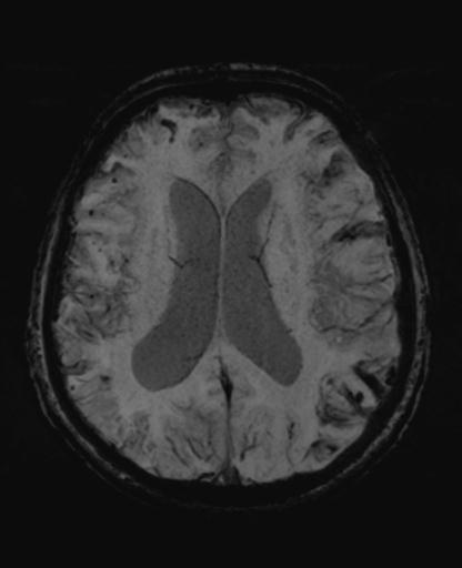 File:Amyloid angiopathy with inflammation (Radiopaedia 30360-31002 Axial SWI MIP 35).jpg