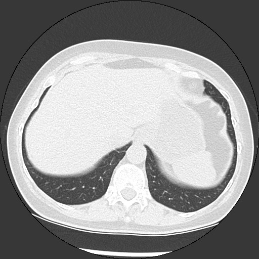 Amyloidosis - bronchial and diffuse nodular pulmonary involvement (Radiopaedia 60156-67744 B 50).jpg