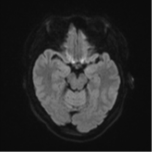 File:Anaplastic astroblastoma (Radiopaedia 55666-62194 Axial DWI 39).png