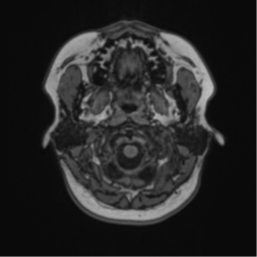 Anaplastic astroblastoma (Radiopaedia 55666-62194 Axial T1 4).png