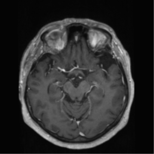 File:Anaplastic astrocytoma IDH wild-type (pseudoprogression) (Radiopaedia 42209-45278 Axial T1 C+ 68).png