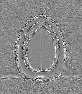 Anaplastic oligodendroglioma (Radiopaedia 83500-98599 Axial SWI - phase 78).png