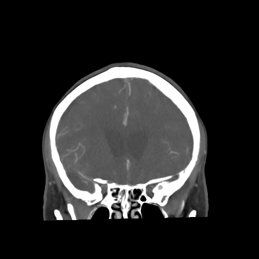 Aneursym related subarachnoid hemorrhage with hydrocephalus (Radiopaedia 45105-49084 B 26).jpg