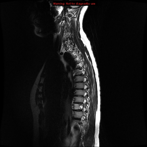 File:Aneurysmal bone cyst (Radiopaedia 9419-10103 G 1).jpg