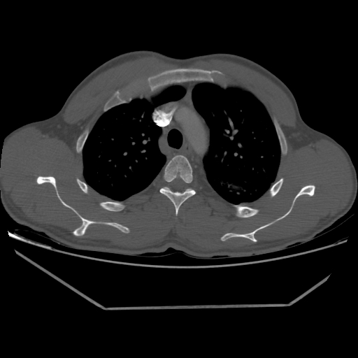 Aneurysmal bone cyst - rib (Radiopaedia 82167-96220 Axial bone window 91).jpg
