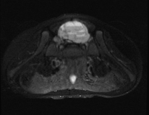File:Aneurysmal bone cyst - sacrum (Radiopaedia 65190-74196 Axial T2 fat sat 6).jpg