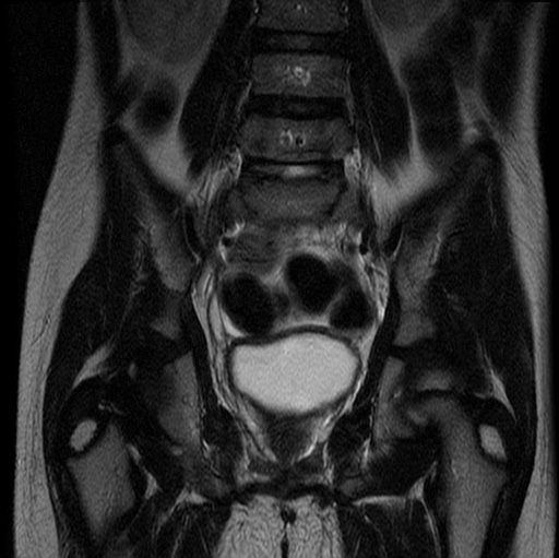 File:Aneurysmal bone cyst - sacrum (Radiopaedia 65190-74196 Coronal T2 16).jpg