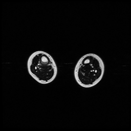 File:Aneurysmal bone cyst - tibia (Radiopaedia 22343-22367 Axial T2 7).jpg