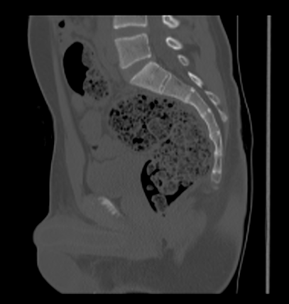 Aneurysmal bone cyst of ischium (Radiopaedia 25957-26094 Sagittal bone window 37).png