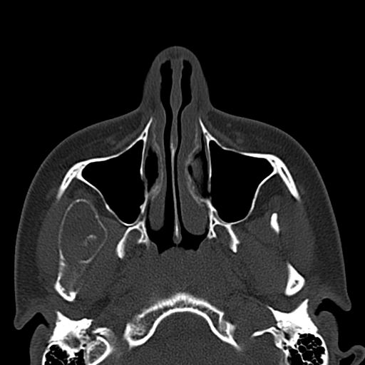 Aneurysmal bone cyst of the mandible (Radiopaedia 43280-46601 Axial bone window 67).jpg