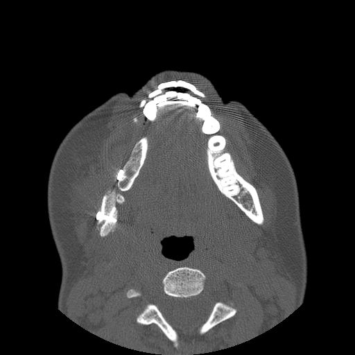 Aneurysmal bone cyst of the mandible (Radiopaedia 43280-46823 Axial bone window 55).jpg