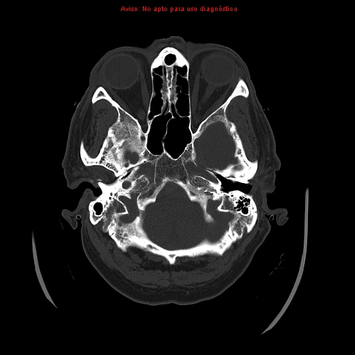 File:Aneurysmal subarachnoid hemorrhage (Radiopaedia 24740-24997 bone window 7).jpg