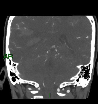 File:Aneurysmal subarachnoid hemorrhage with intra-axial extension (Radiopaedia 84371-99732 C 38).jpg