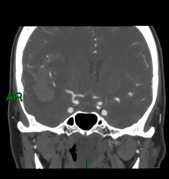 Aneurysmal subarachnoid hemorrhage with intra-axial extension (Radiopaedia 84371-99732 C 59).jpg