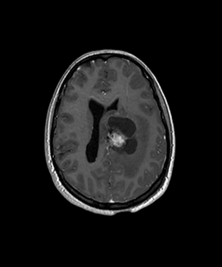 Angiomatous meningioma (Radiopaedia 79459-92577 Axial T1 C+ 3D ISO 18).jpg