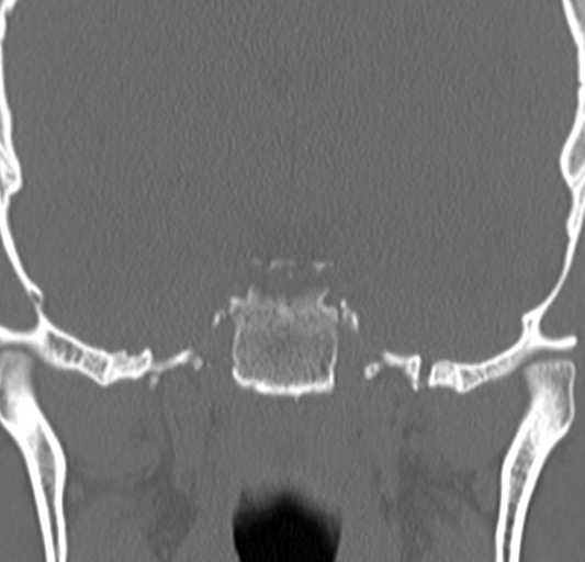 Angular epidermoid cyst (Radiopaedia 46908-51439 Coronal bone window 53).png