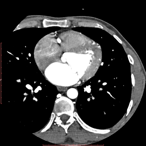File:Anomalous left coronary artery from the pulmonary artery (ALCAPA) (Radiopaedia 70148-80181 A 181).jpg