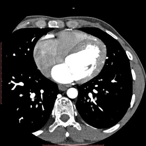 File:Anomalous left coronary artery from the pulmonary artery (ALCAPA) (Radiopaedia 70148-80181 A 216).jpg