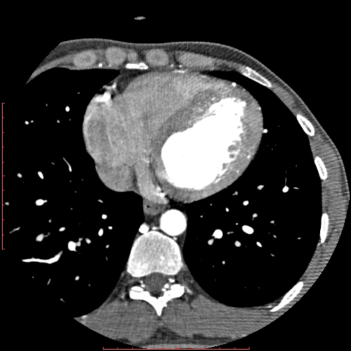 File:Anomalous left coronary artery from the pulmonary artery (ALCAPA) (Radiopaedia 70148-80181 A 251).jpg