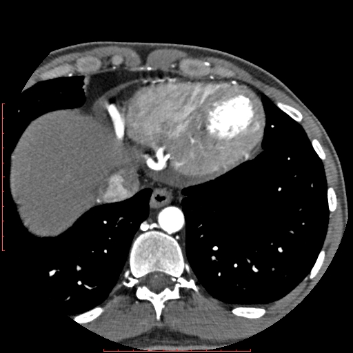 Anomalous left coronary artery from the pulmonary artery (ALCAPA) (Radiopaedia 70148-80181 A 331).jpg