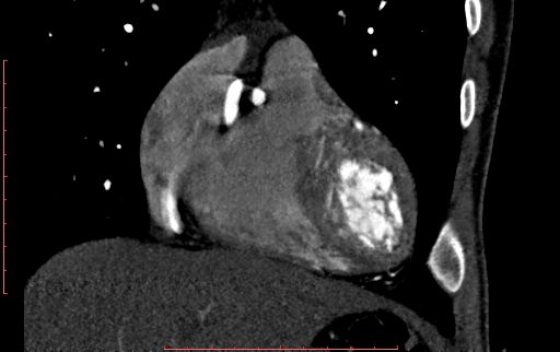 Anomalous left coronary artery from the pulmonary artery (ALCAPA) (Radiopaedia 70148-80181 B 83).jpg