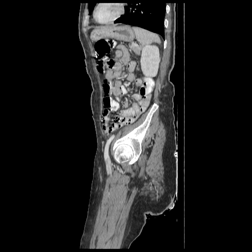 Anorectal carcinoma (Radiopaedia 44413-48064 C 84).jpg