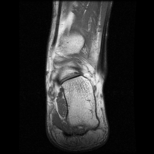 File:Anterior calcaneal process fracture (Radiopaedia 74654-85611 Coronal T1 18).jpg