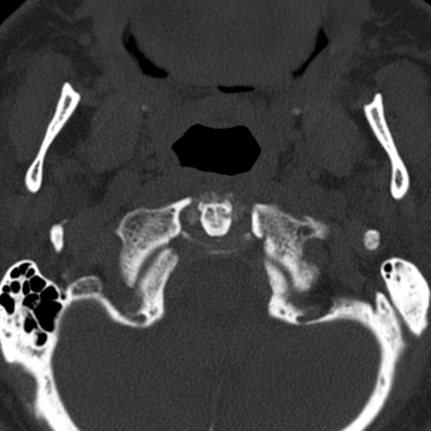 Anterior cervical postdiscectomy arthrodesis (Radiopaedia 32678-33646 Axial bone window 10).jpg