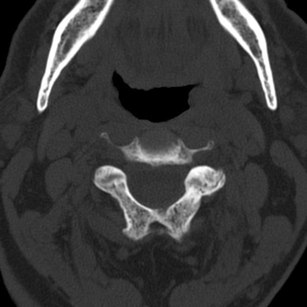 Anterior cervical postdiscectomy arthrodesis (Radiopaedia 32678-33646 Axial bone window 24).jpg