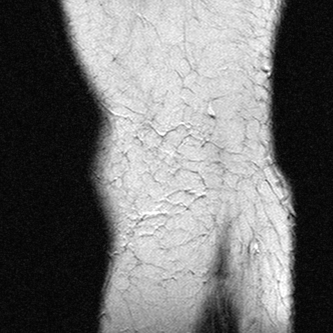 File:Anterior cruciate ligament mucoid degeneration (Radiopaedia 60853-68633 Sagittal T2 27).jpg