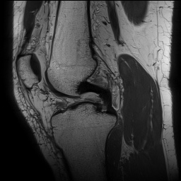 Anterior cruciate ligament rupture with Segond fracture (Radiopaedia 69043-78806 Sagittal PD 87).jpg