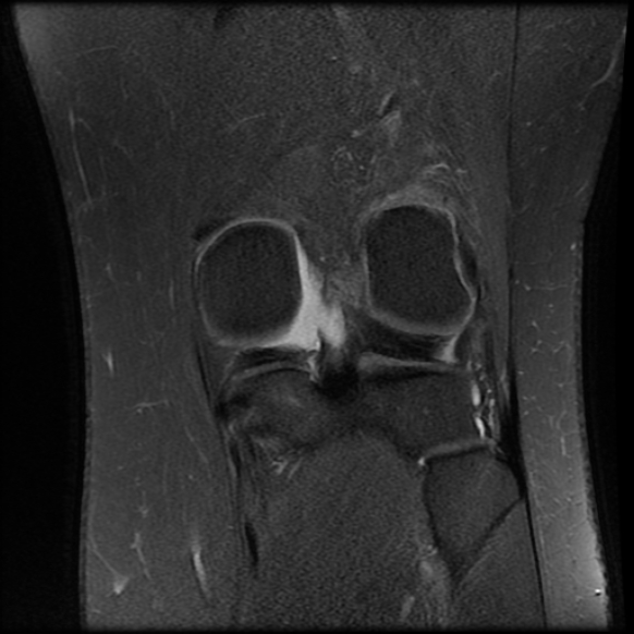 File:Anterior cruciate ligament tear, Wrisberg rip and bucket-handle tear of medial meniscus (Radiopaedia 75872-87266 Coronal PD fat sat 20).jpg