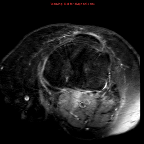 File:Anterior cruciate ligament tear (Radiopaedia 12329-12612 Axial T2 fat sat 6).jpg